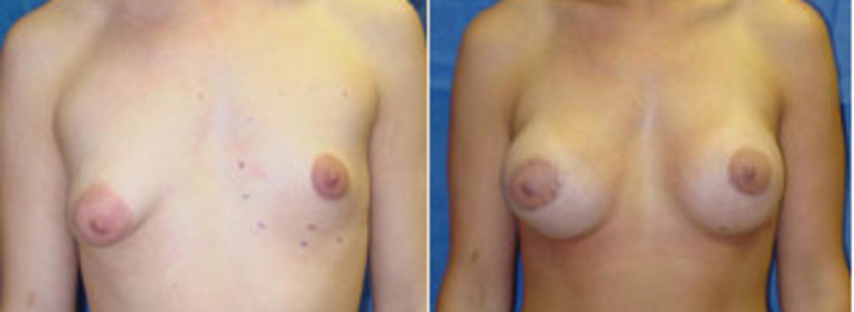 Before & After Breast Lift Case 9 View #1 View in Birmingham, AL