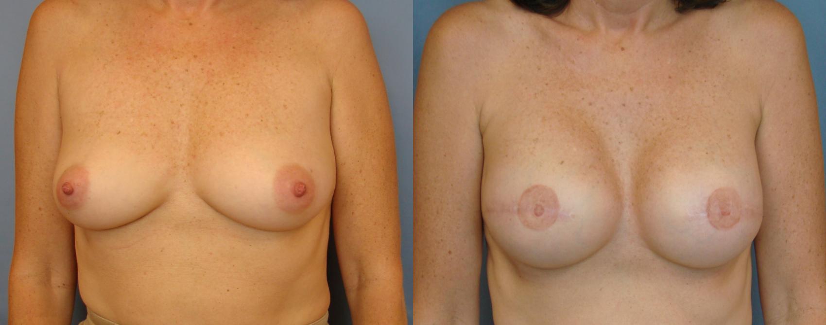 Before & After Breast Reconstruction Case 75 View #1 View in Birmingham, AL