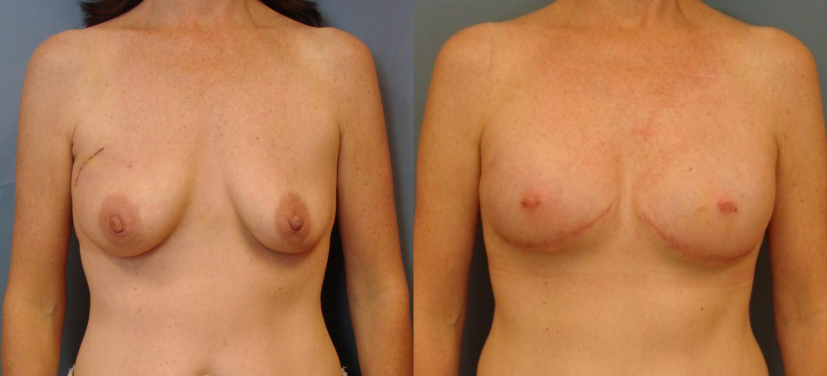 Before & After Breast Reconstruction Case 76 View #1 View in Birmingham, AL