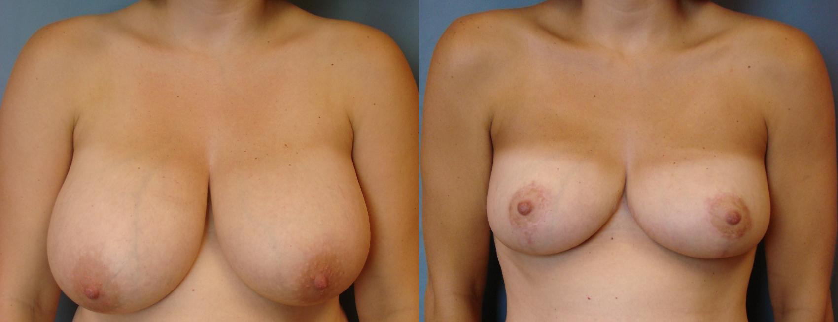 Before & After Breast Reduction Case 81 View #1 View in Birmingham, AL