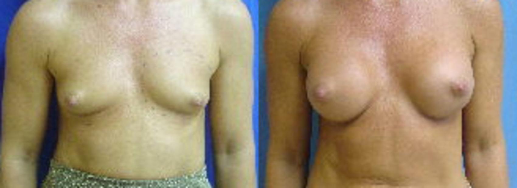 Before & After Breast Augmentation Case 10 View #1 View in Birmingham, AL