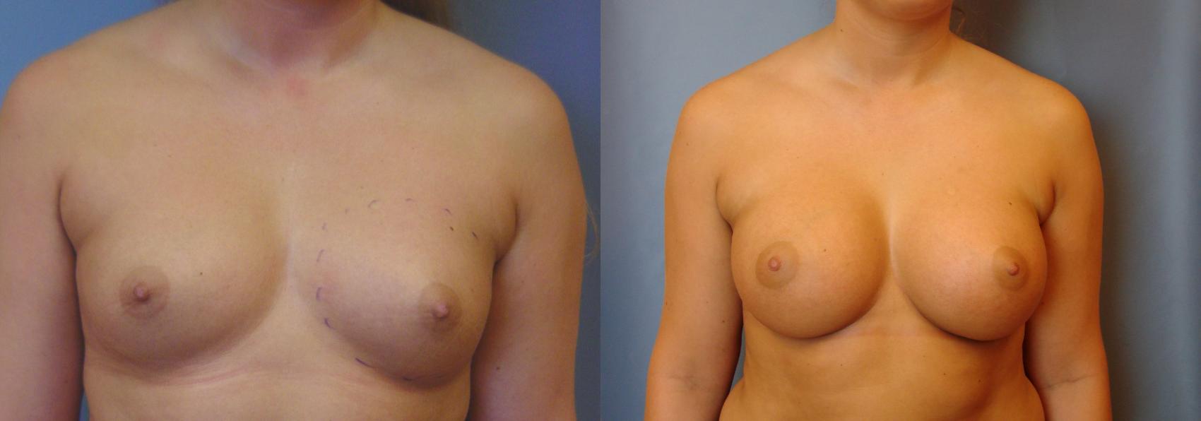 Before & After Breast Augmentation Case 22 View #1 View in Birmingham, AL