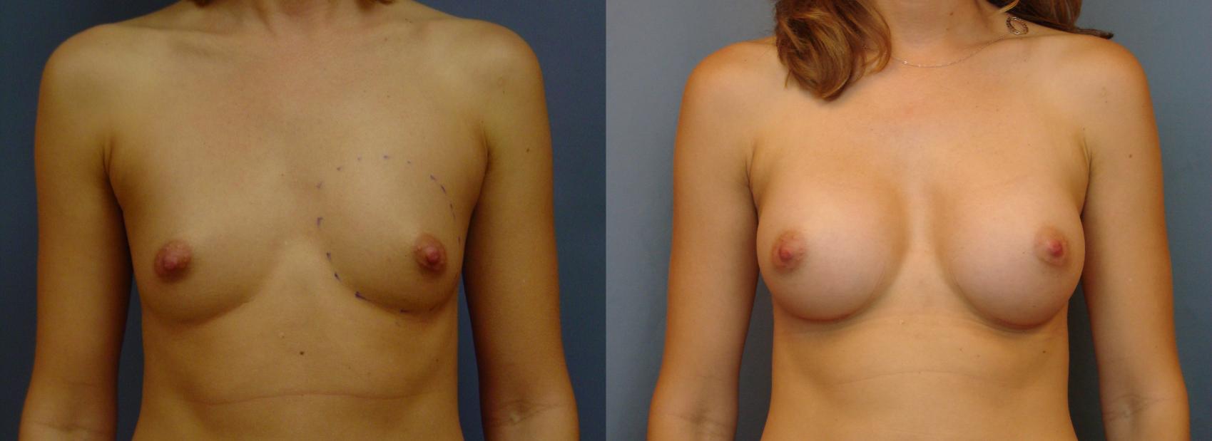 Before & After Breast Augmentation Case 23 View #1 View in Birmingham, AL