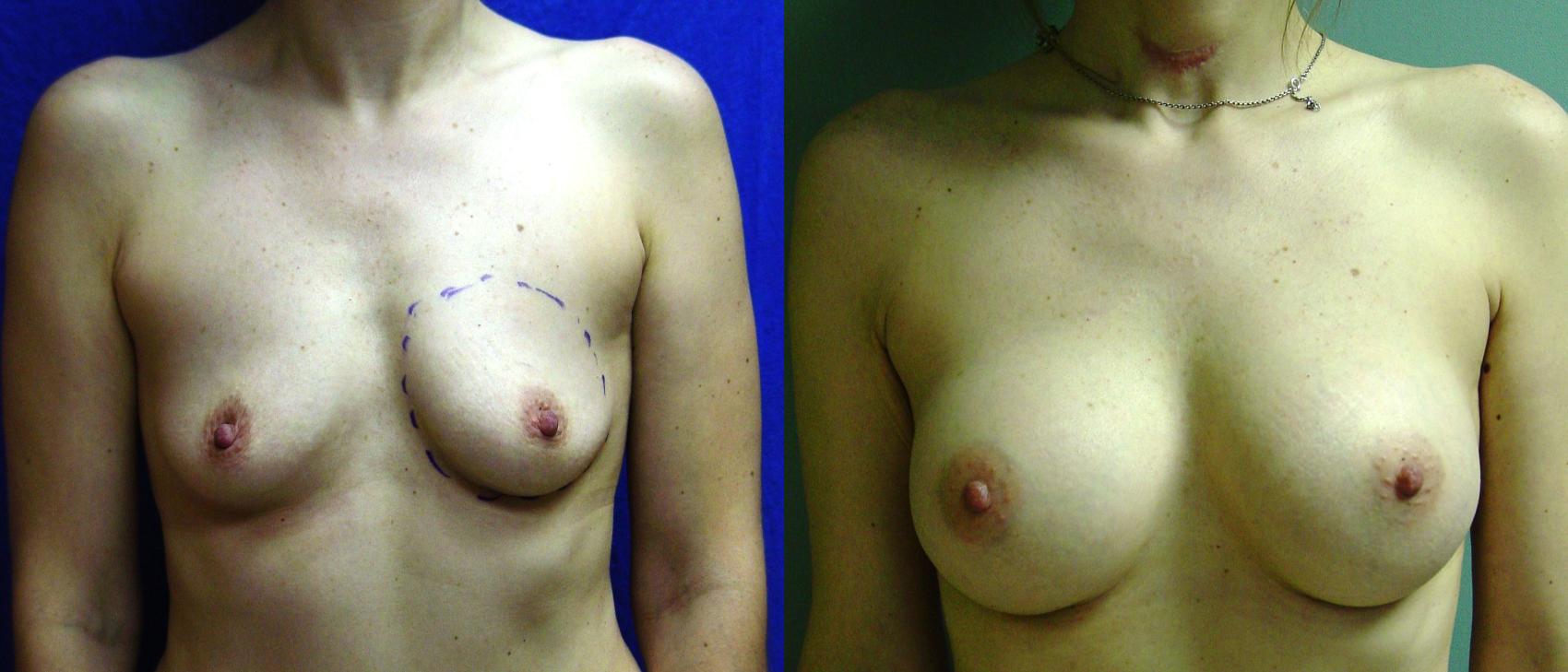 Before & After Breast Augmentation Case 24 View #1 View in Birmingham, AL