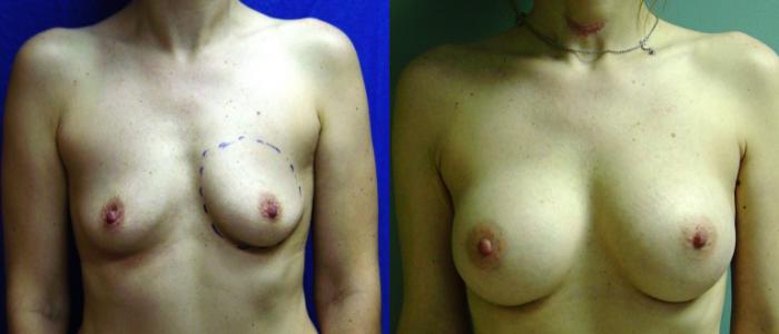 Before & After Breast Augmentation Case 24 View #1 View in Birmingham, AL