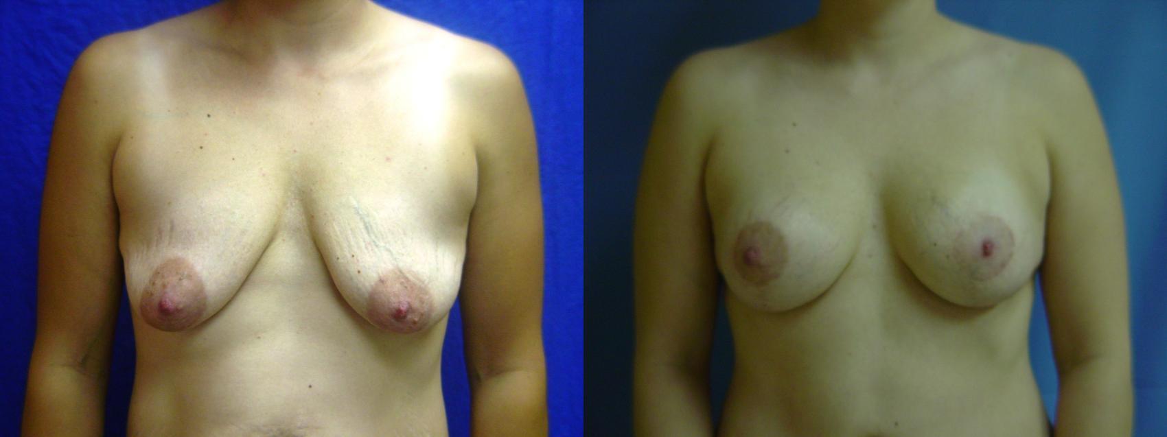 Before & After Breast Augmentation Case 25 View #1 View in Birmingham, AL