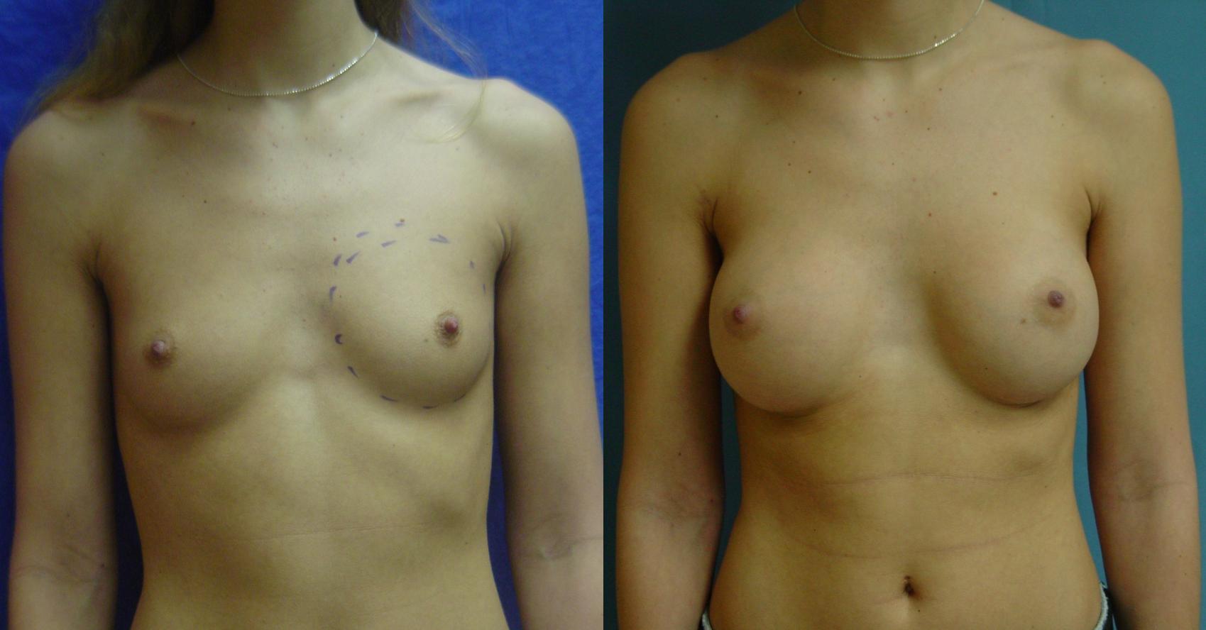 Before & After Breast Augmentation Case 27 View #1 View in Birmingham, AL