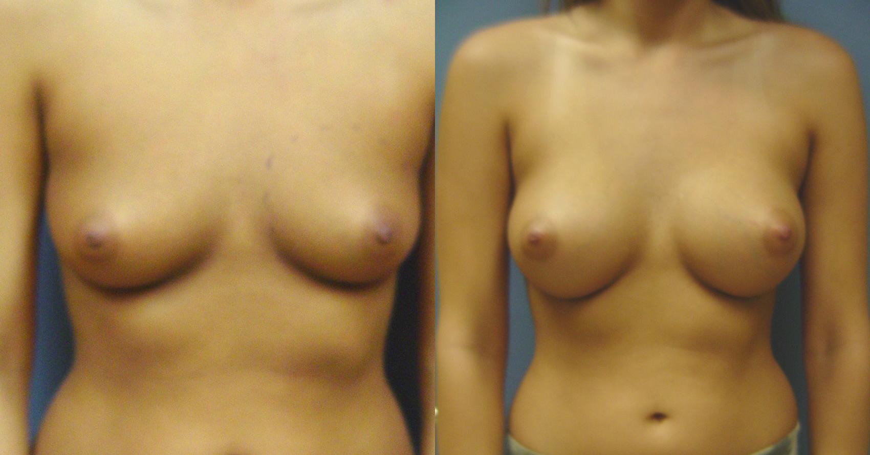 Before & After Breast Augmentation Case 28 View #1 View in Birmingham, AL