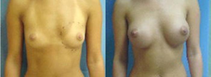 Before & After Breast Augmentation Case 3 View #1 View in Birmingham, AL