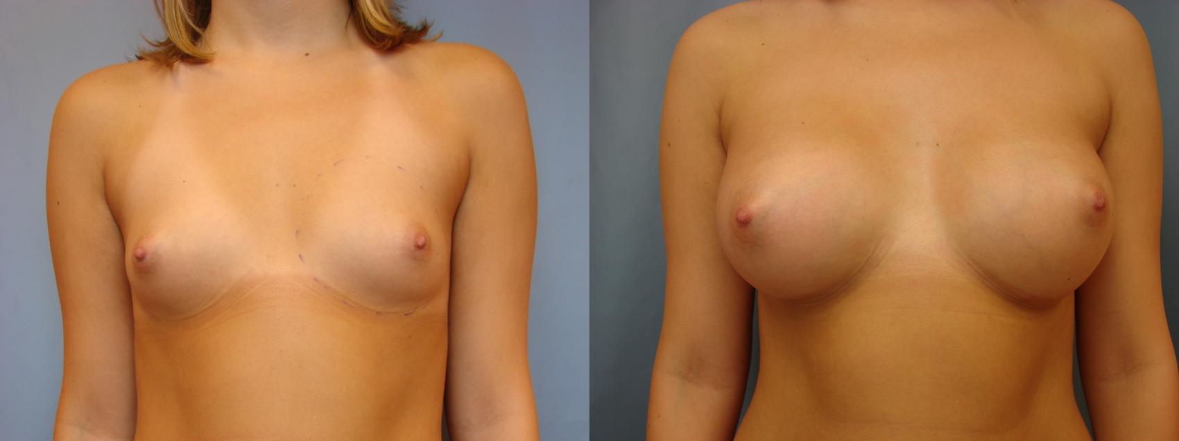 Before & After Breast Augmentation Case 31 View #1 View in Birmingham, AL