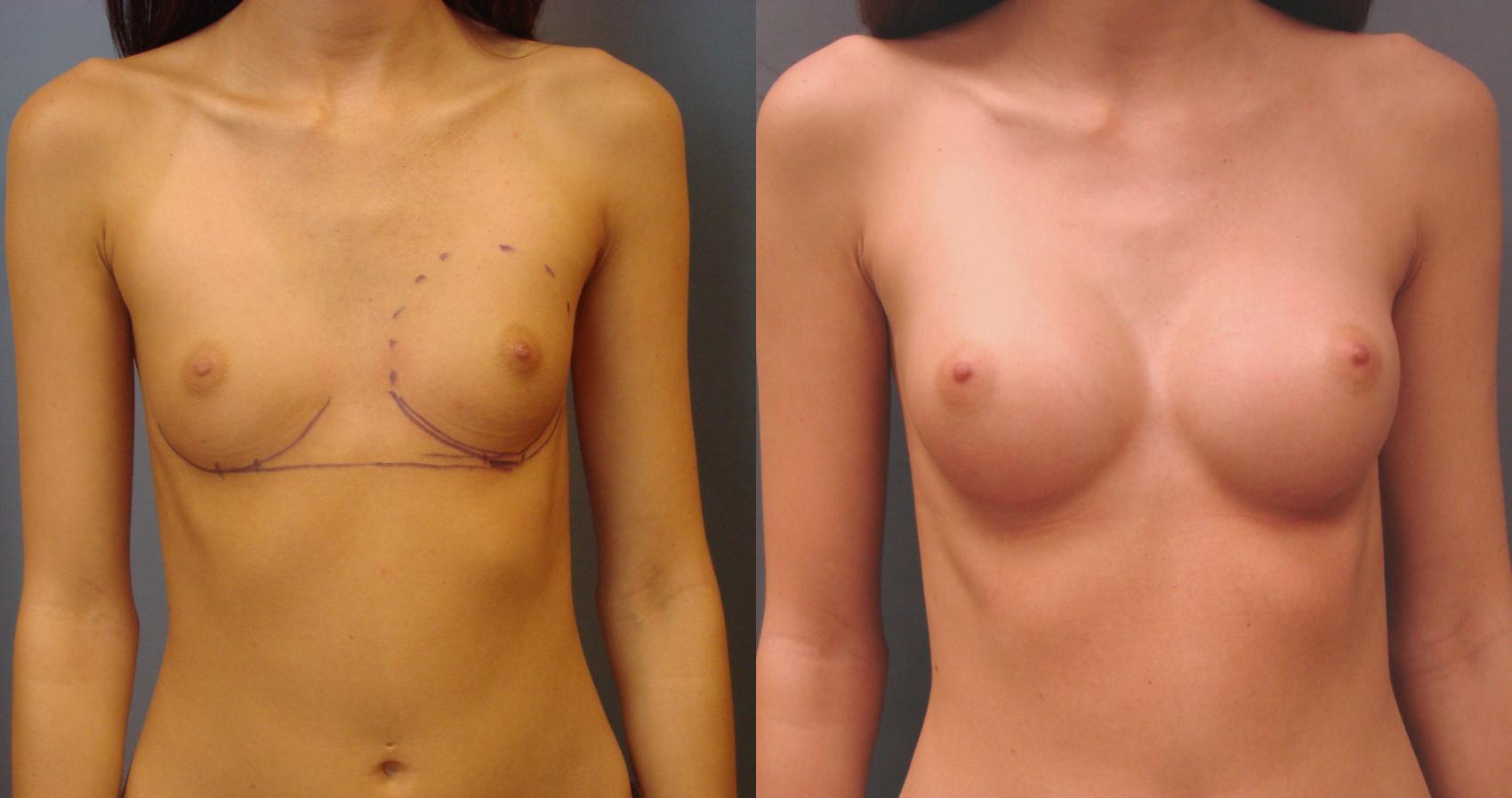 Before & After Breast Augmentation Case 32 View #1 View in Birmingham, AL