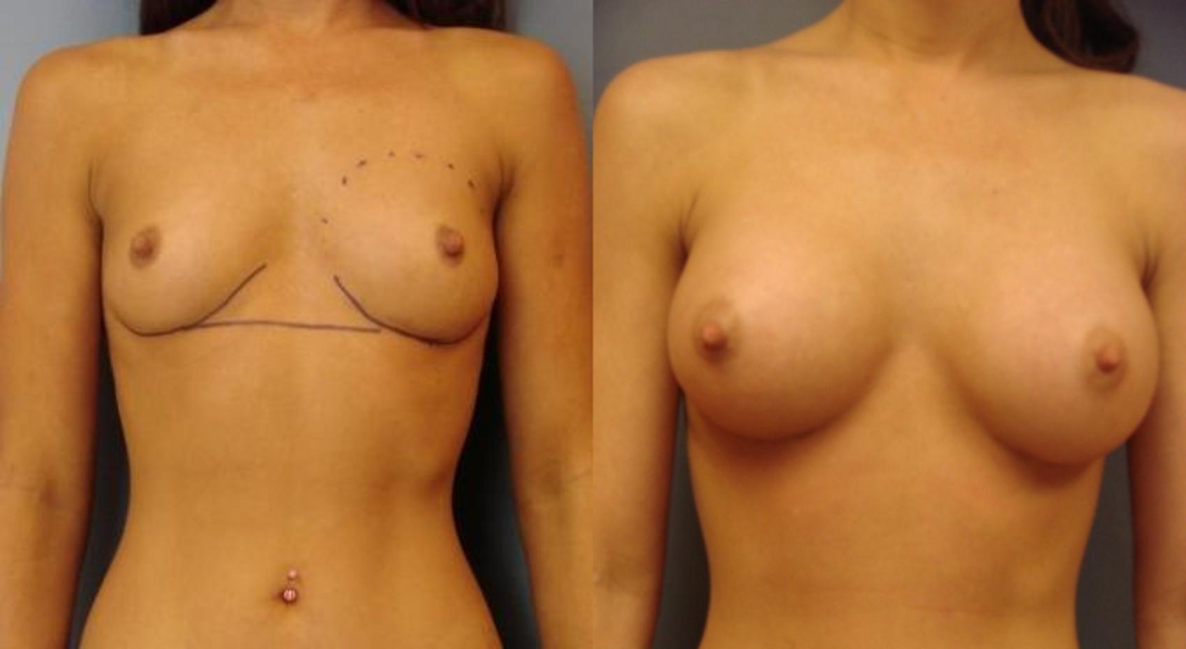 Before & After Breast Augmentation Case 37 View #1 View in Birmingham, AL
