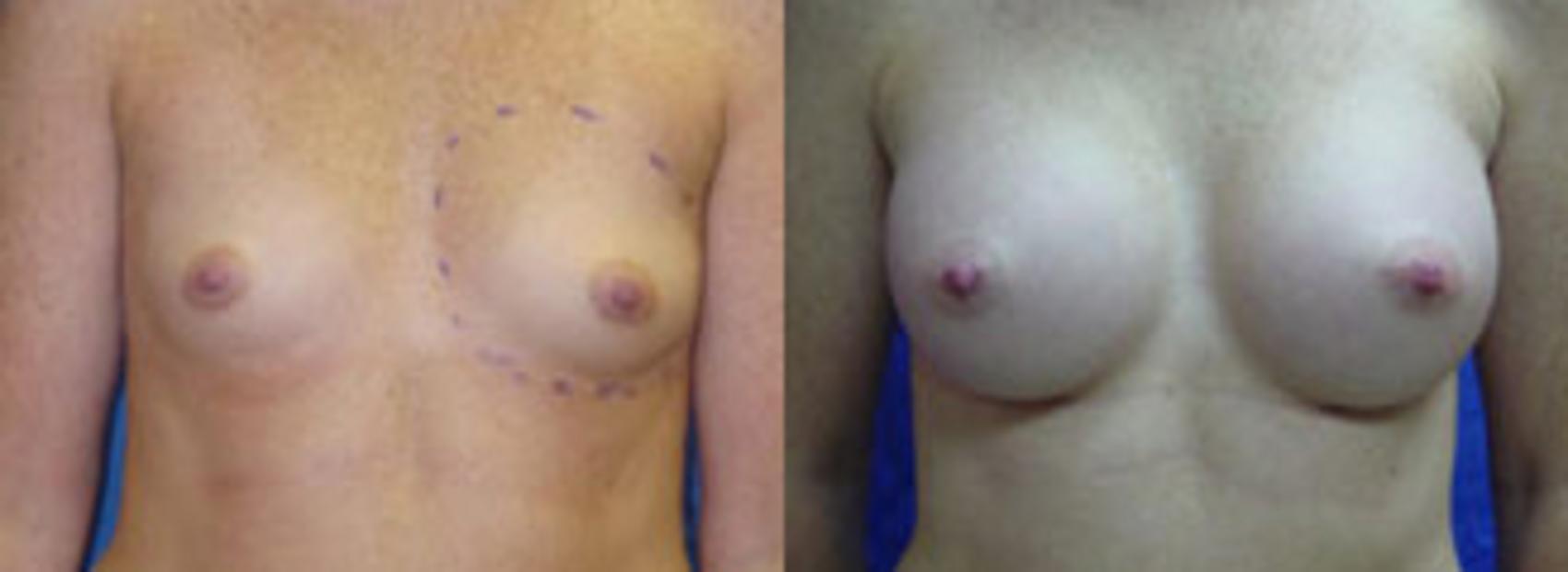 Before & After Breast Augmentation Case 4 View #1 View in Birmingham, AL