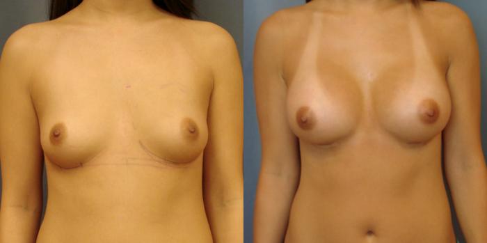 Before & After Breast Augmentation Case 41 View #1 View in Birmingham, AL