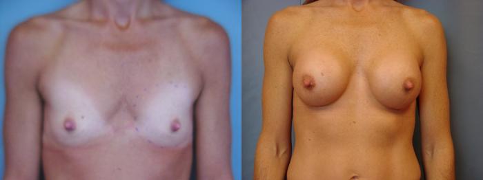 Before & After Breast Augmentation Case 42 View #1 View in Birmingham, AL