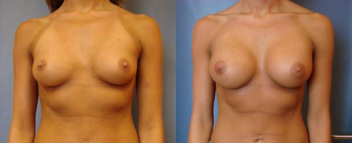 Before & After Breast Augmentation Case 43 View #1 View in Birmingham, AL