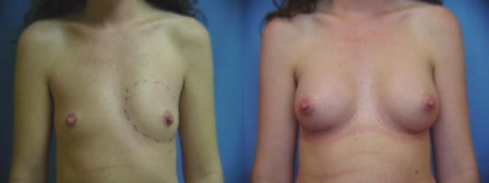 Before & After Breast Augmentation Case 45 View #1 View in Birmingham, AL