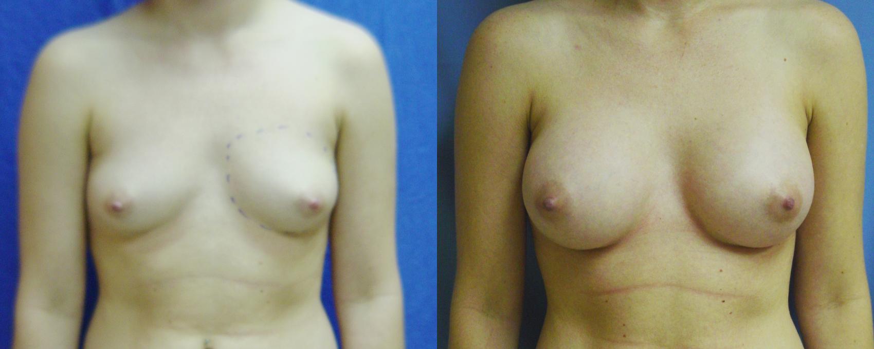 Before & After Breast Augmentation Case 46 View #1 View in Birmingham, AL