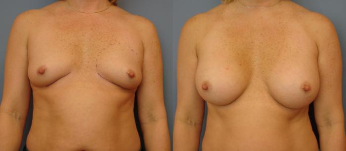 Before & After Breast Augmentation Case 47 View #1 View in Birmingham, AL