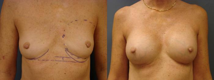 Before & After Breast Augmentation Case 48 View #1 View in Birmingham, AL