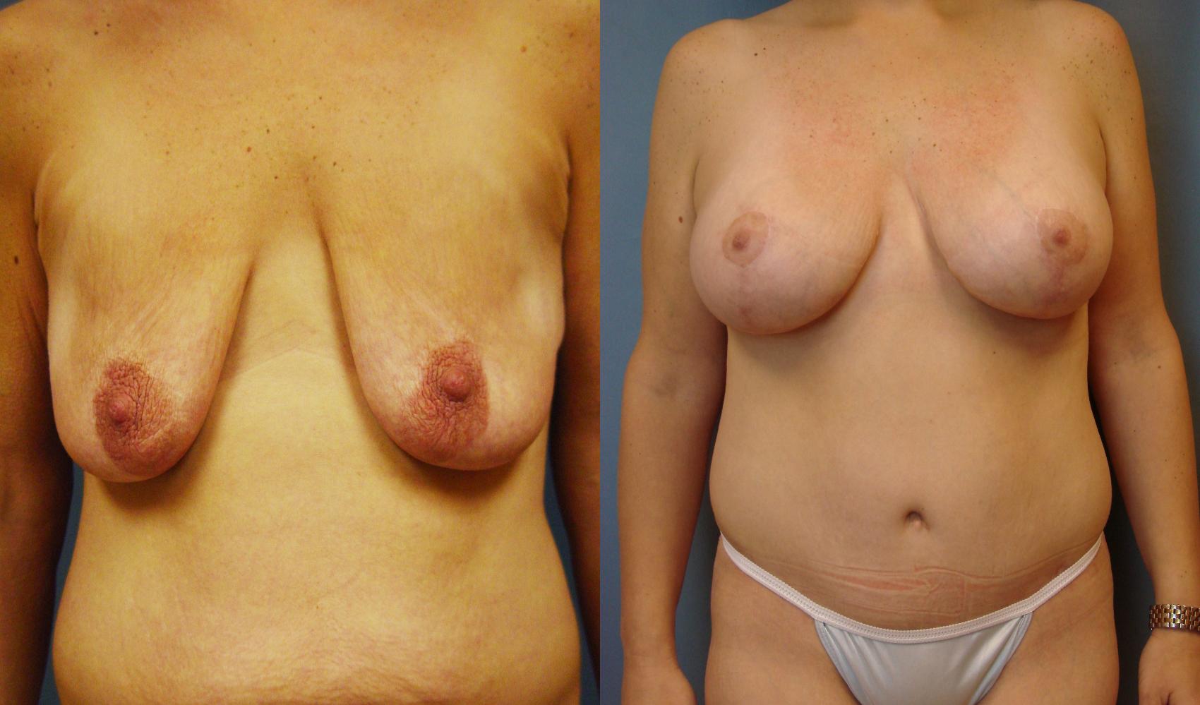 Before & After Breast Augmentation Case 49 View #1 View in Birmingham, AL