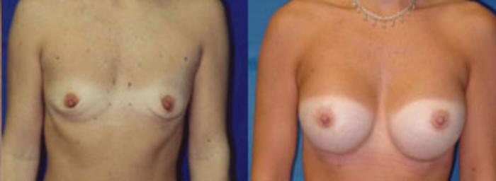 Before & After Breast Augmentation Case 5 View #1 View in Birmingham, AL