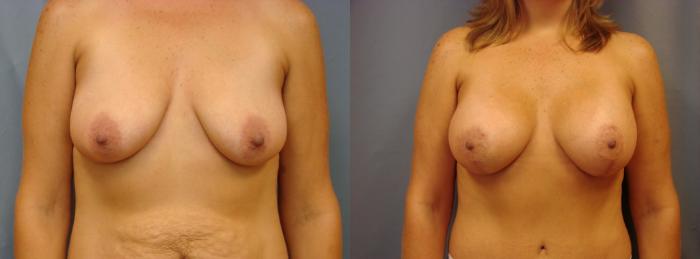 Before & After Breast Augmentation Case 50 View #1 View in Birmingham, AL