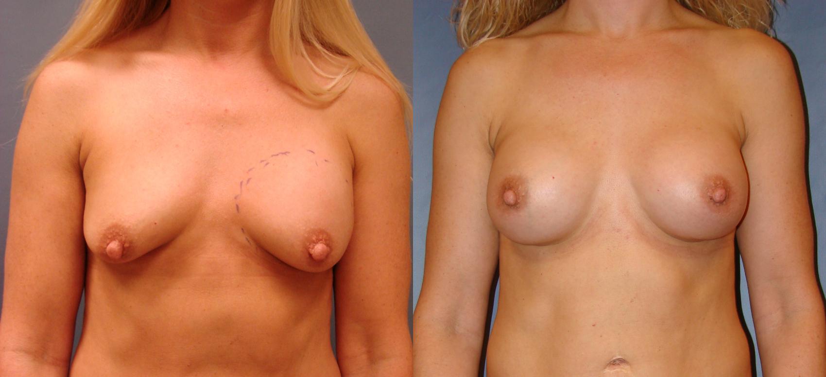 Before & After Breast Augmentation Case 56 View #1 View in Birmingham, AL
