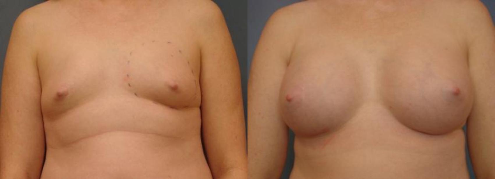 Before & After Breast Augmentation Case 58 View #1 View in Birmingham, AL