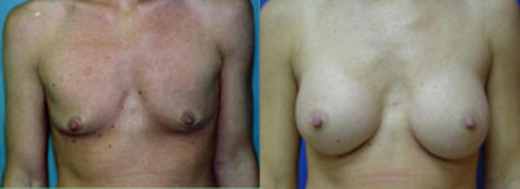 Before & After Breast Augmentation Case 6 View #1 View in Birmingham, AL