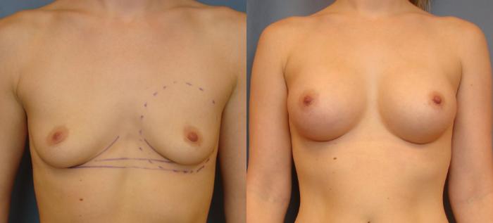 Before & After Breast Augmentation Case 68 View #1 View in Birmingham, AL