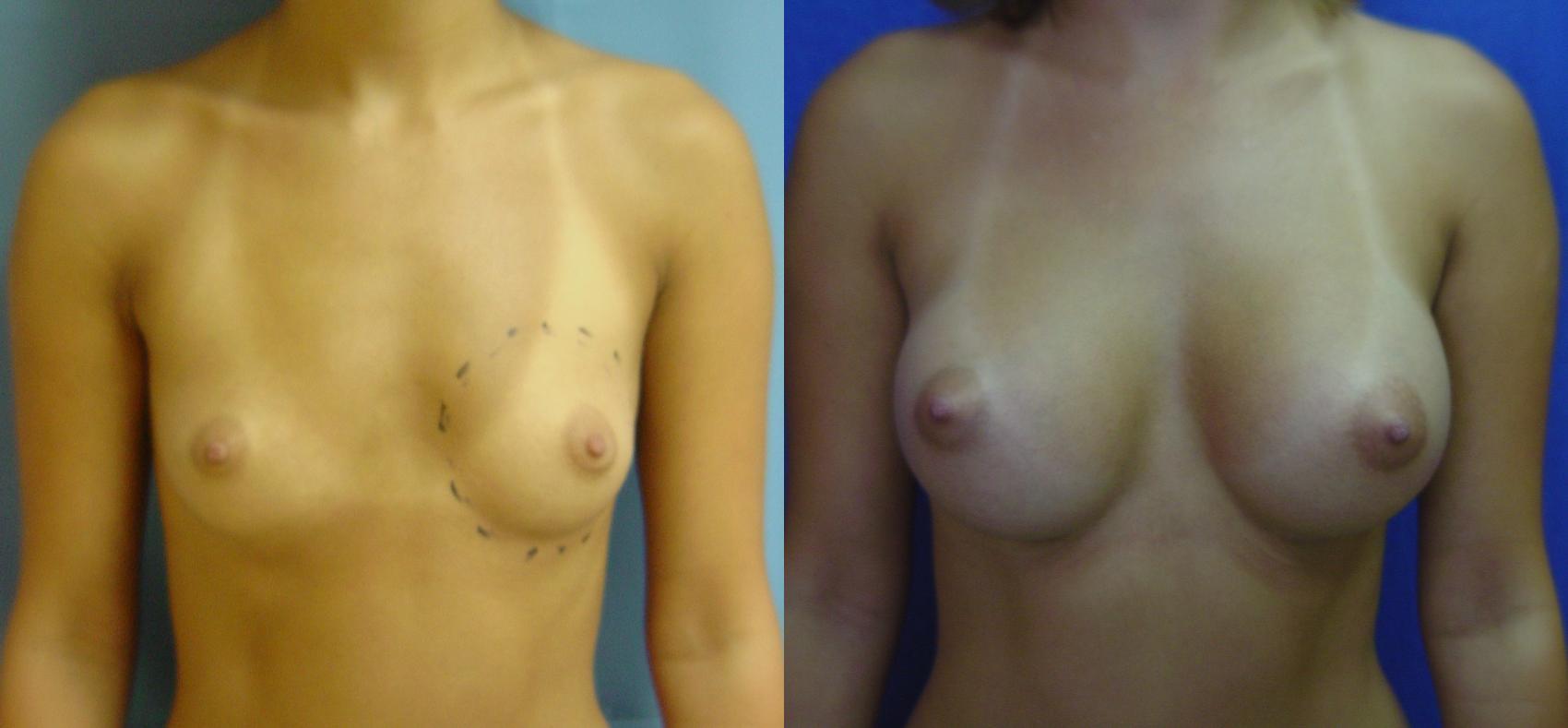 Before & After Breast Augmentation Case 69 View #1 View in Birmingham, AL
