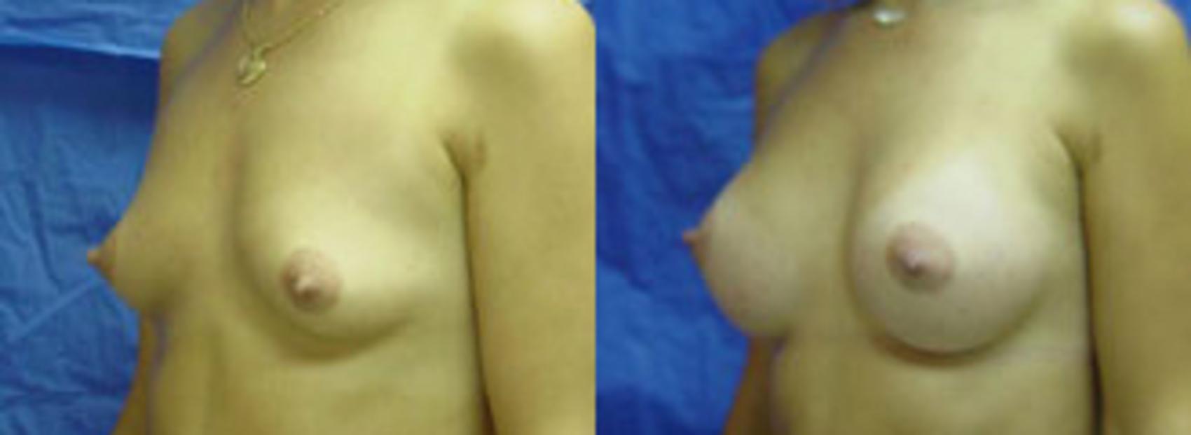 Before & After Breast Augmentation Case 7 View #1 View in Birmingham, AL