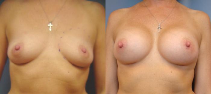 Before & After Breast Augmentation Case 70 View #1 View in Birmingham, AL