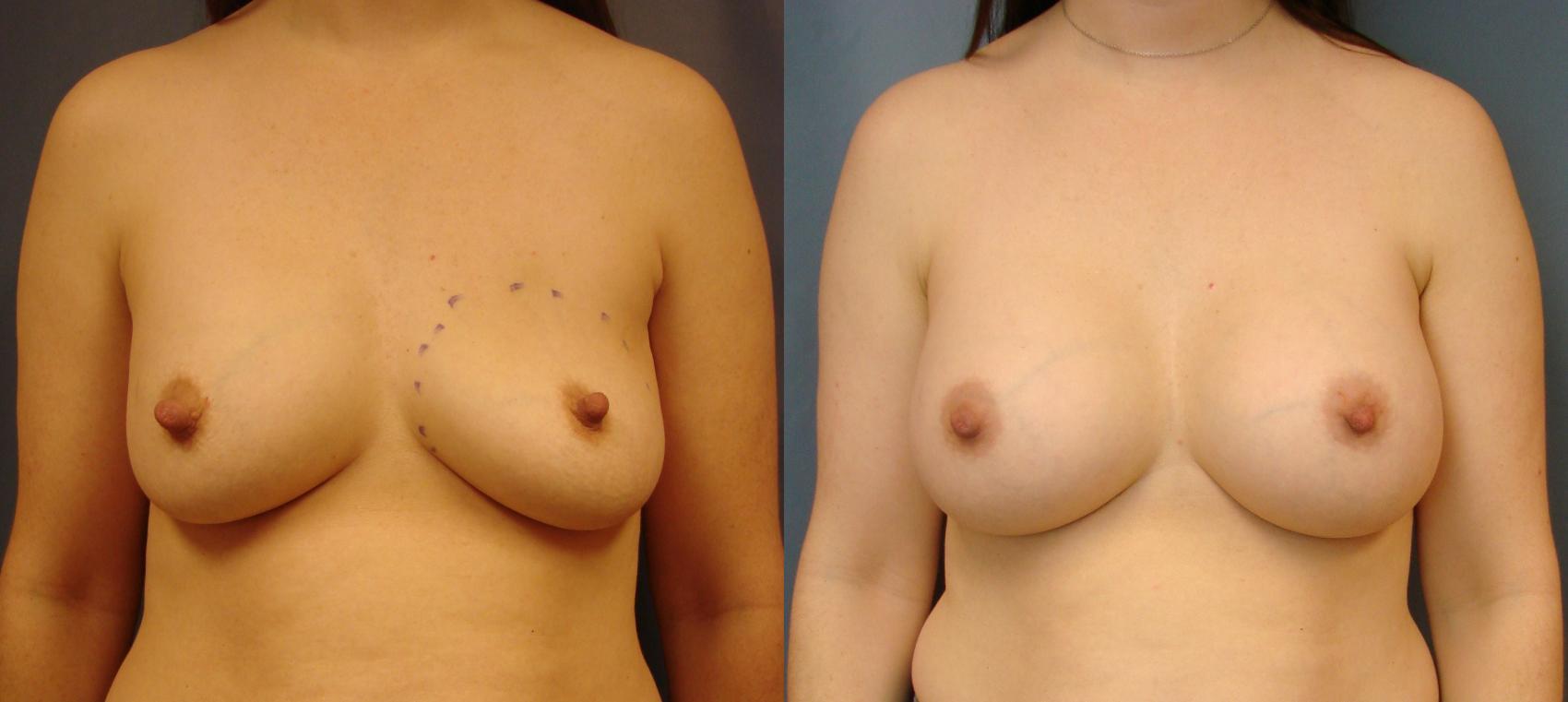 Before & After Breast Augmentation Case 73 View #1 View in Birmingham, AL