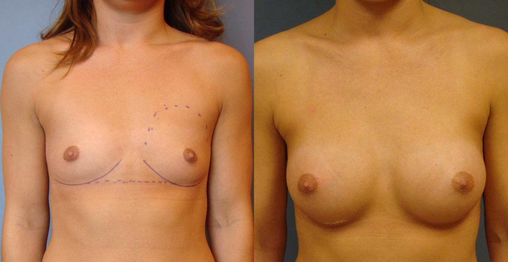 Before & After Breast Augmentation Case 77 View #1 View in Birmingham, AL