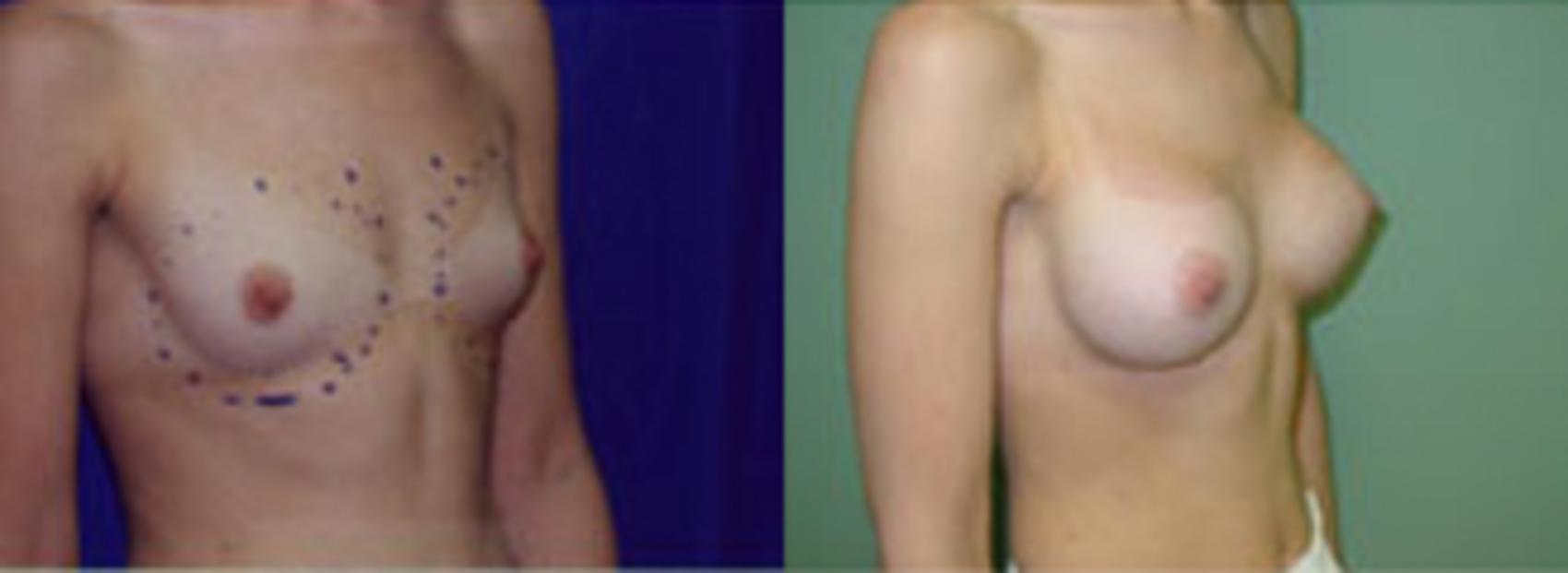 Before & After Breast Augmentation Case 8 View #1 View in Birmingham, AL