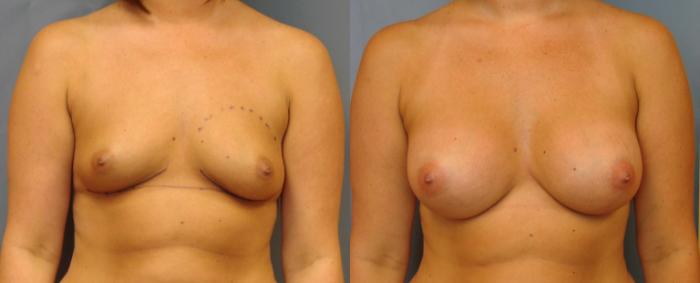Before & After Breast Augmentation Case 80 View #1 View in Birmingham, AL