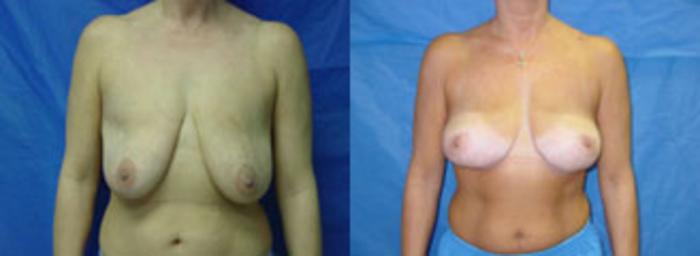 Before & After Breast Lift Case 19 View #1 View in Birmingham, AL