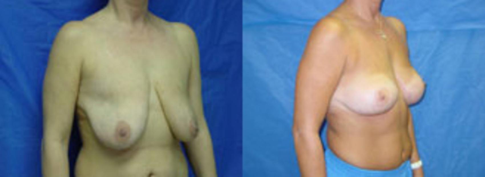 Before & After Breast Lift Case 19 View #3 View in Birmingham, AL