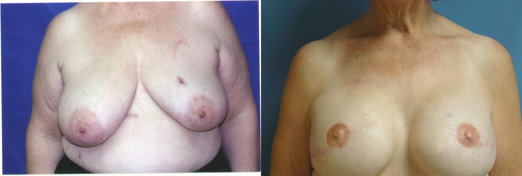 Before & After Breast Reconstruction Case 21 View #1 View in Birmingham, AL