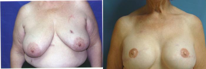Before & After Breast Reconstruction Case 21 View #1 View in Birmingham, AL