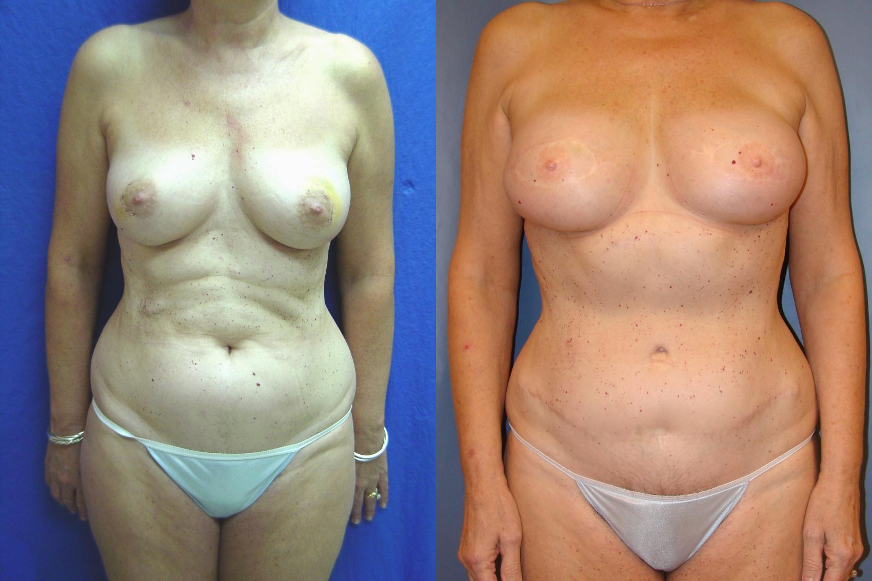 Before & After Breast Reconstruction Case 34 View #1 View in Birmingham, AL