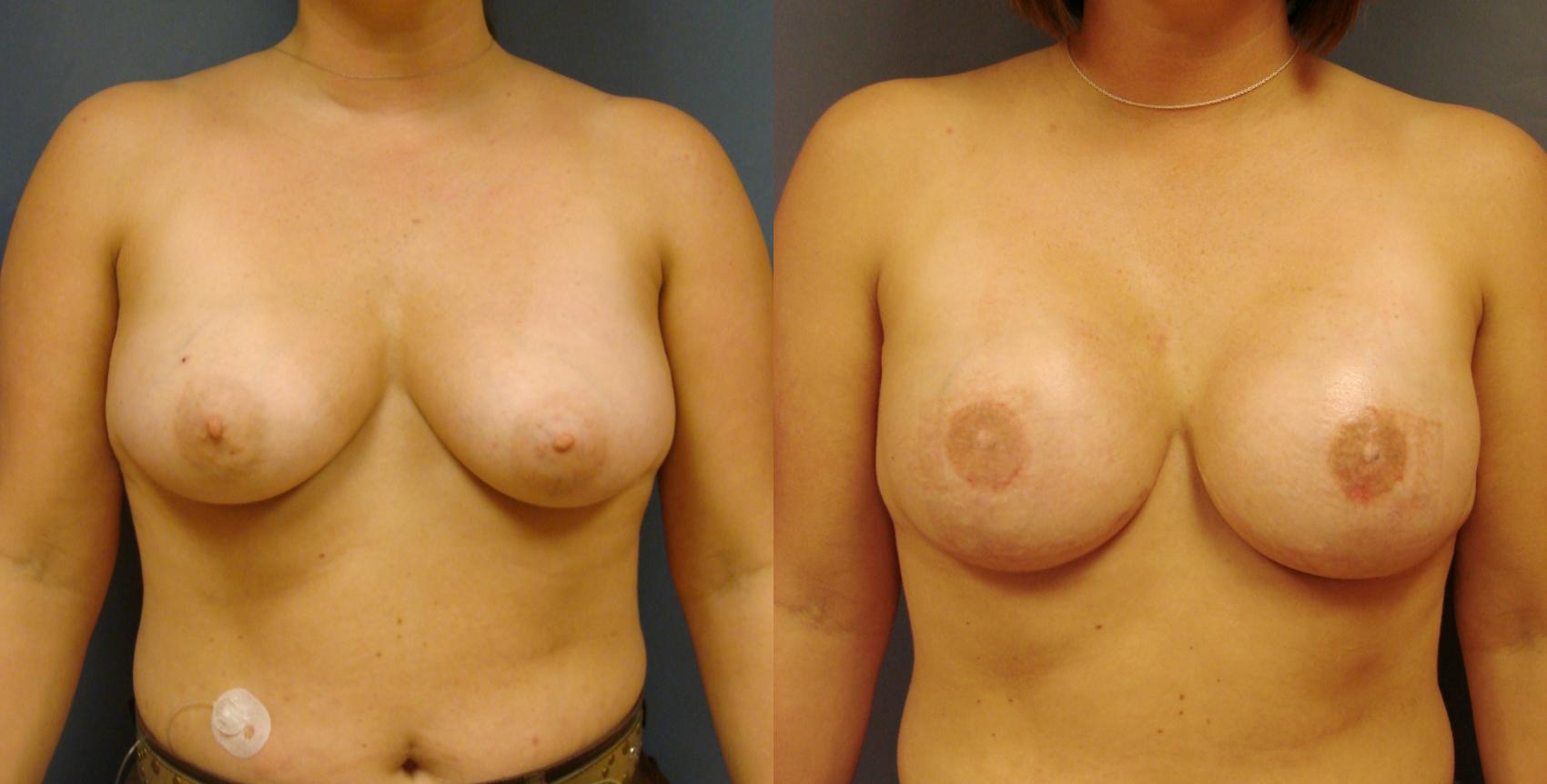 Before & After Breast Reconstruction Case 52 View #1 View in Birmingham, AL