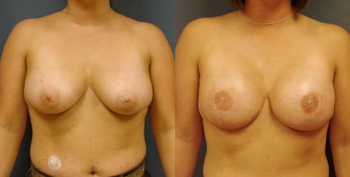 Before & After Breast Reconstruction Case 52 View #1 View in Birmingham, AL