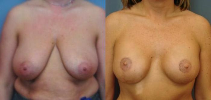 Before & After Breast Reconstruction Case 54 View #1 View in Birmingham, AL