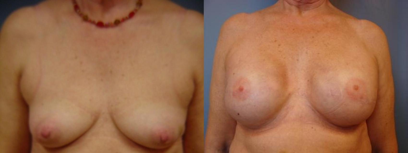 Before & After Breast Reconstruction Case 55 View #1 View in Birmingham, AL