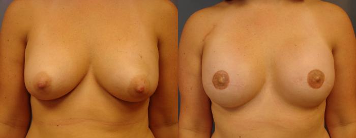 Before & After Breast Reconstruction Case 61 View #1 View in Birmingham, AL