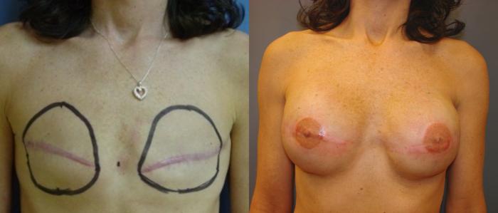 Before & After Breast Reconstruction Case 62 View #1 View in Birmingham, AL