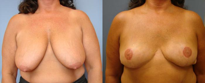 Before & After Breast Reconstruction Case 63 View #1 View in Birmingham, AL